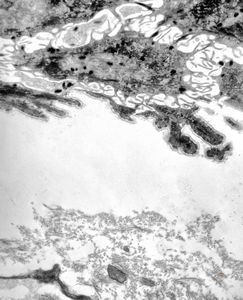 F, 41y. | epidermolysis bullosa … dystrophic type F, 41y. | epidermolysis bullosa … dystrophic type